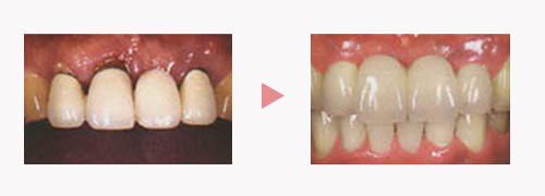 オールセラミック｜審美歯科｜渡辺歯科