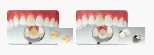 メタルボンド・ハイブリッド｜審美歯科｜渡辺歯科