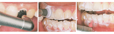 ＰＭＴＣ（物理的カリエス予防）予防歯科｜渡辺歯科