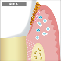 口腔内の免疫機能 歯周治療について|渡辺歯科