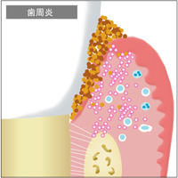 口腔内の免疫機能 歯周治療について|渡辺歯科